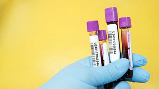 Un nuevo análisis de sangre detecta cinco tipos de cáncer cuatro años antes que los métodos convencionales